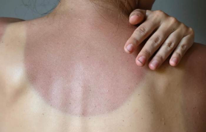 Hyperpigmentation & Tanning