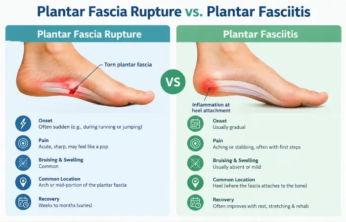 Plantar Fascia Rupture vs. Plantar Fasciitis